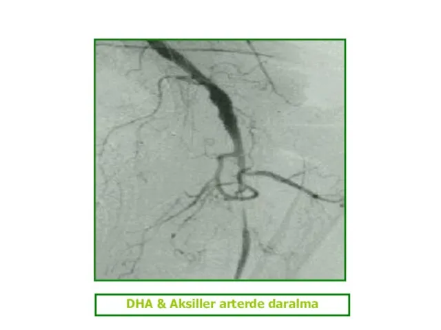 DHA & Aksiller arterde daralma