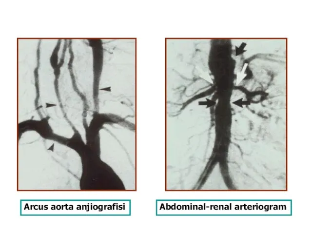 Arcus aorta anjiografisi Abdominal-renal arteriogram