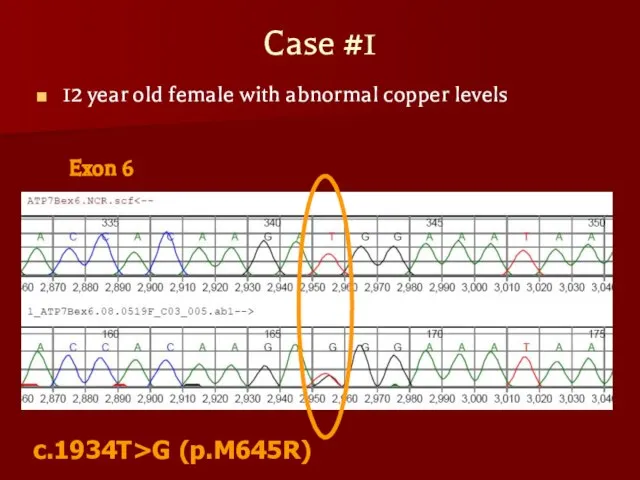 Case #1 12 year old female with abnormal copper levels Exon 6 c.1934T>G (p.M645R)