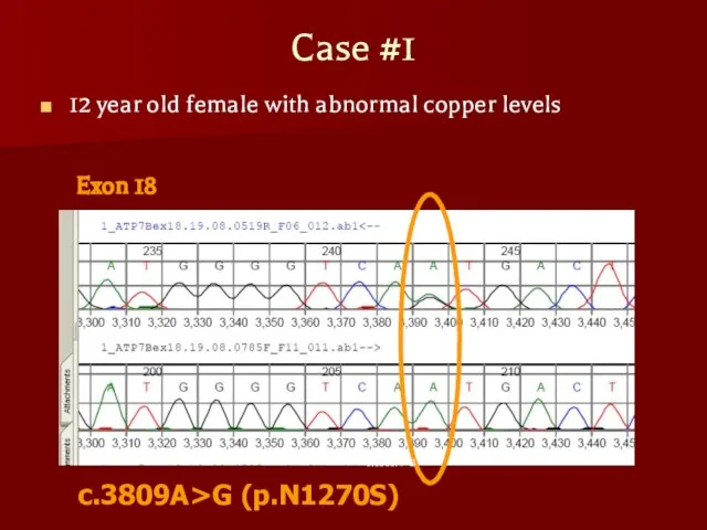 Case #1 12 year old female with abnormal copper levels Exon 18 c.3809A>G (p.N1270S)