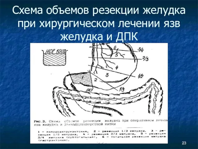 Схема объемов резекции желудка при хирургическом лечении язв желудка и ДПК