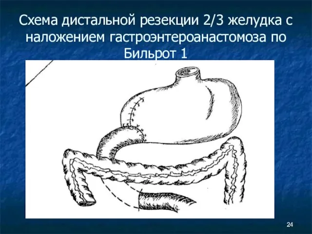 Схема дистальной резекции 2/3 желудка с наложением гастроэнтероанастомоза по Бильрот 1