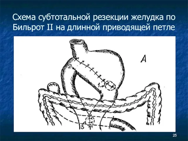 Схема субтотальной резекции желудка по Бильрот II на длинной приводящей петле