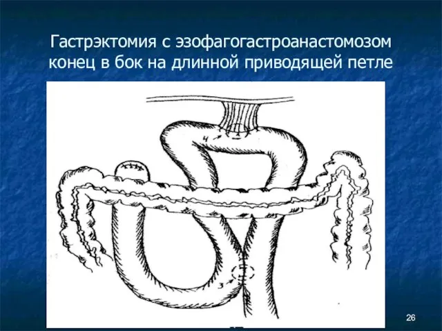 Гастрэктомия с эзофагогастроанастомозом конец в бок на длинной приводящей петле