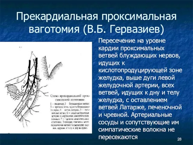 Прекардиальная проксимальная ваготомия (В.Б. Гервазиев) Пересечение на уровне кардии проксимальных ветвей блуждающих