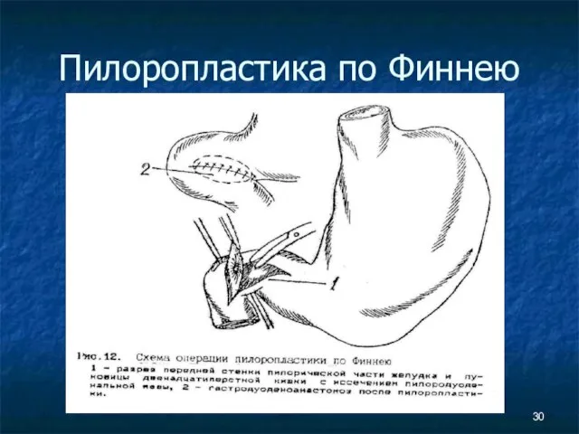 Пилоропластика по Финнею