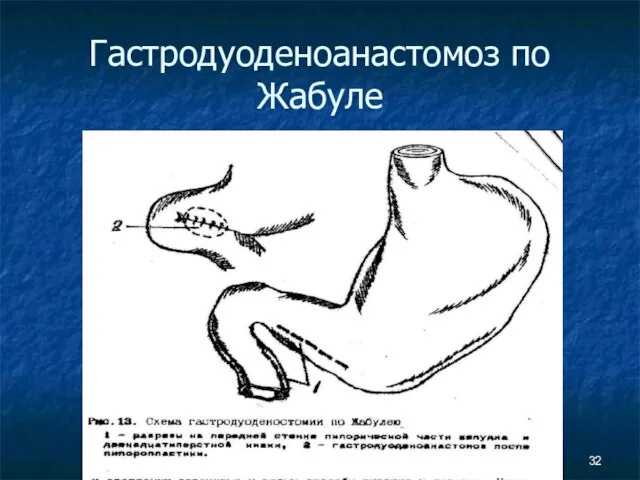 Гастродуоденоанастомоз по Жабуле