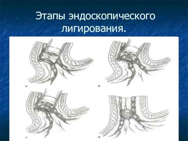 Этапы эндоскопического лигирования.