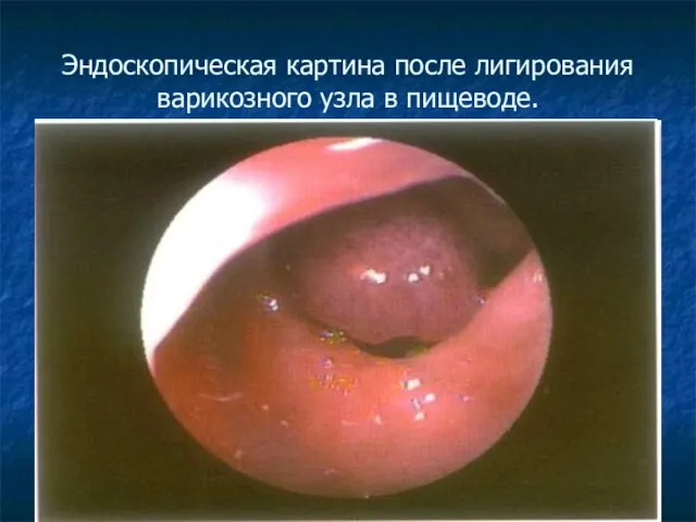 Эндоскопическая картина после лигирования варикозного узла в пищеводе.