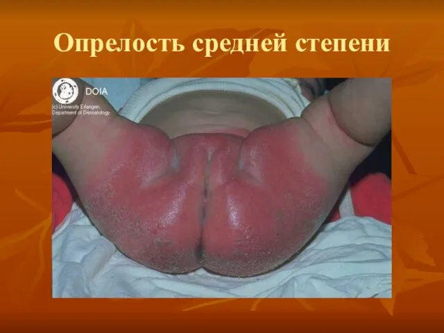 Опрелость средней степени