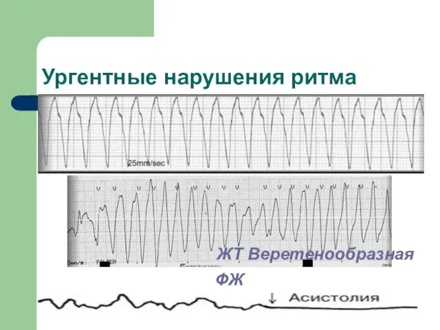 Ургентные нарушения ритма ФЖ ЖТ Веретенообразная