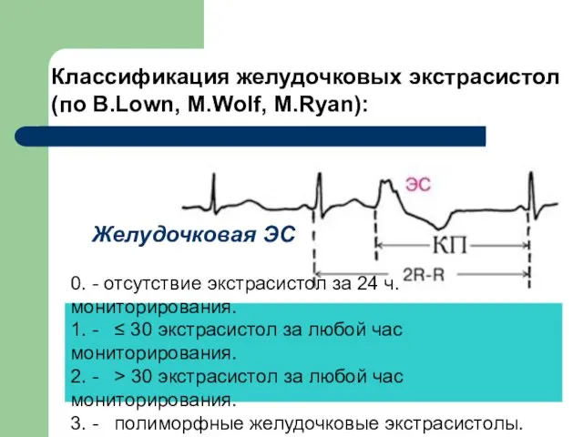 0. - отсутствие экстрасистол за 24 ч. мониторирования. 1. - ≤ 30