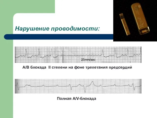 Нарушение проводимости: А/В блокада II степени на фоне трепетания предсердий Полная A/V-блокада