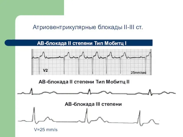 АВ-блокада II степени Тип Мобитц I АВ-блокада II степени Тип Мобитц II