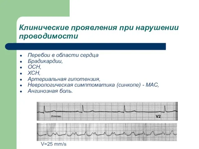 Клинические проявления при нарушении проводимости Перебои в области сердца Брадикардии, ОСН, ХСН,