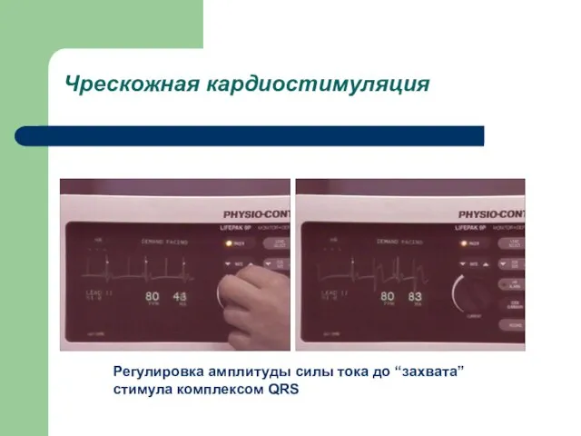 Чрескожная кардиостимуляция Регулировка амплитуды силы тока до “захвата” стимула комплексом QRS