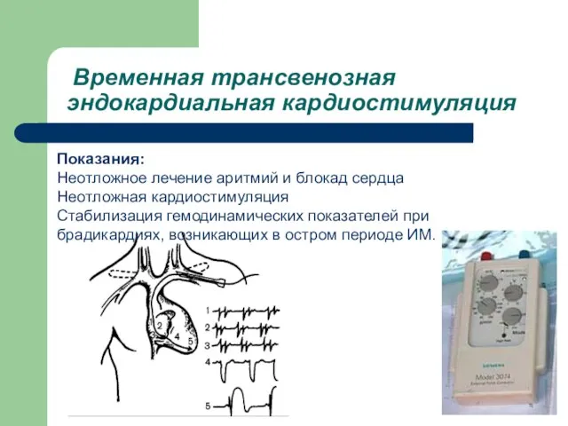 Временная трансвенозная эндокардиальная кардиостимуляция Показания: Неотложное лечение аритмий и блокад сердца Неотложная