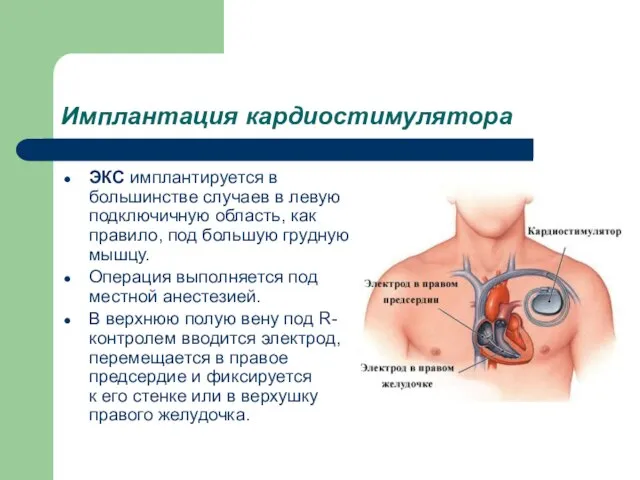 Имплантация кардиостимулятора ЭКС имплантируется в большинстве случаев в левую подключичную область, как