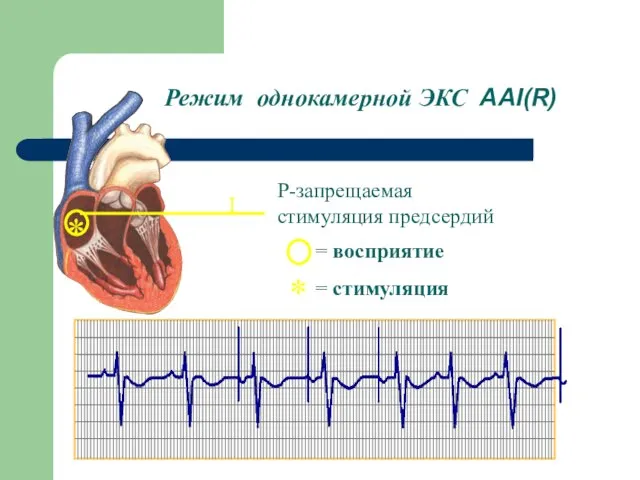 Режим однокамерной ЭКС ААI(R) * AAI(R) * = восприятие = стимуляция I Р-запрещаемая стимуляция предсердий