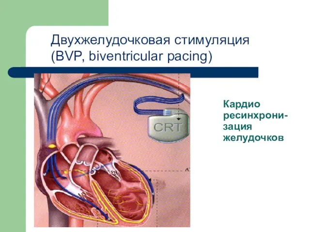 Кардио ресинхрони-зация желудочков Двухжелудочковая стимуляция (BVP, biventricular pacing)