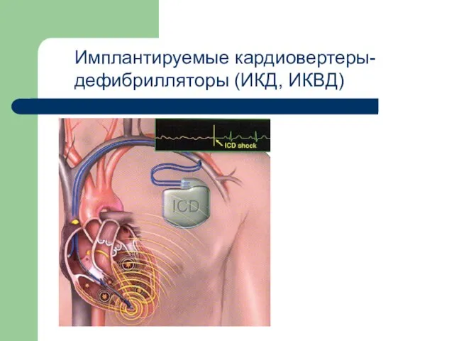 Имплантируемые кардиовертеры- дефибрилляторы (ИКД, ИКВД)