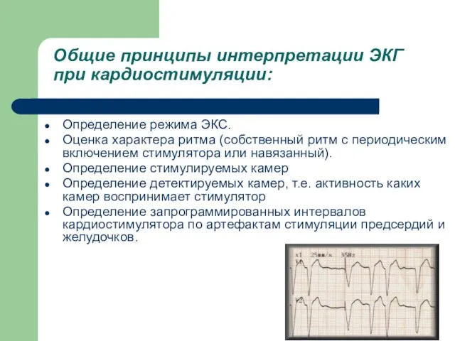 Общие принципы интерпретации ЭКГ при кардиостимуляции: Определение режима ЭКС. Оценка характера ритма