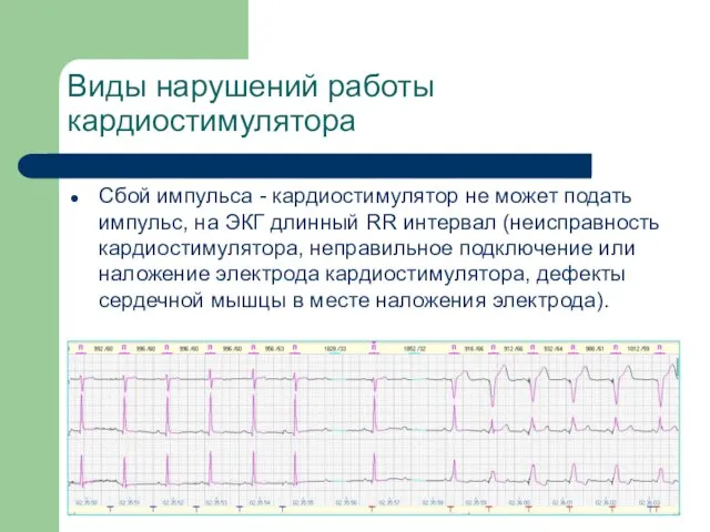 Виды нарушений работы кардиостимулятора Сбой импульса - кардиостимулятор не может подать импульс,