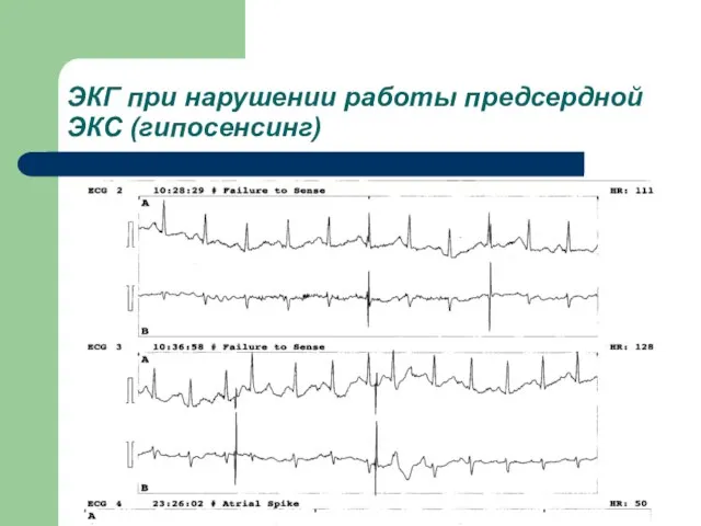 ЭКГ при нарушении работы предсердной ЭКС (гипосенсинг)