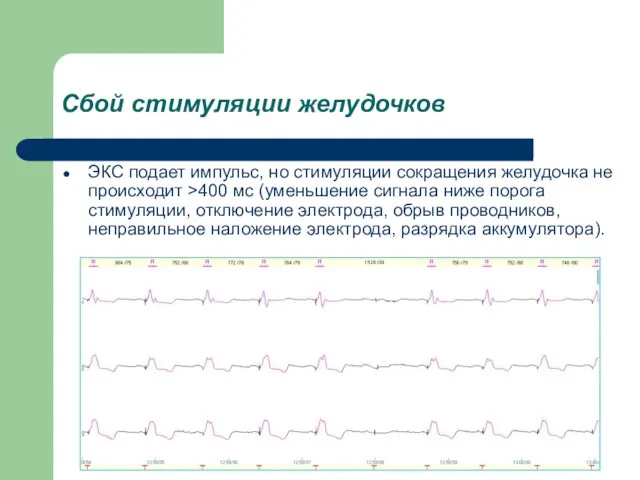 ЭКС подает импульс, но стимуляции сокращения желудочка не происходит >400 мс (уменьшение