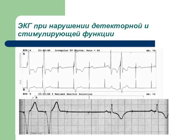 ЭКГ при нарушении детекторной и стимулирующей функции