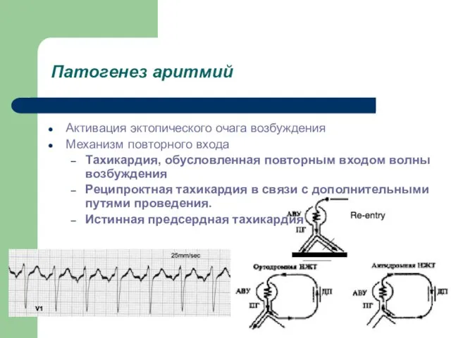 Патогенез аритмий Активация эктопического очага возбуждения Механизм повторного входа Тахикардия, обусловленная повторным