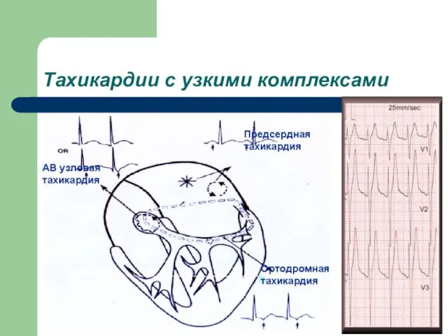 Тахикардии с узкими комплексами