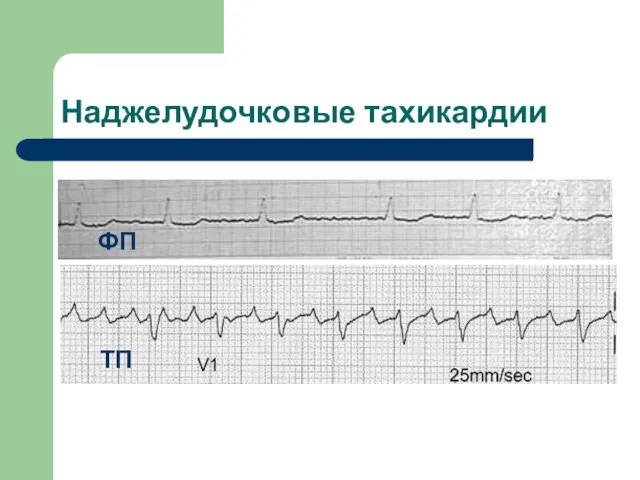 ФП ТП Наджелудочковые тахикардии