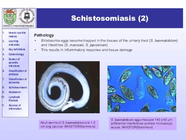 Schistosomiasis (2) Pathology Shistosoma eggs become trapped in the tissues of the