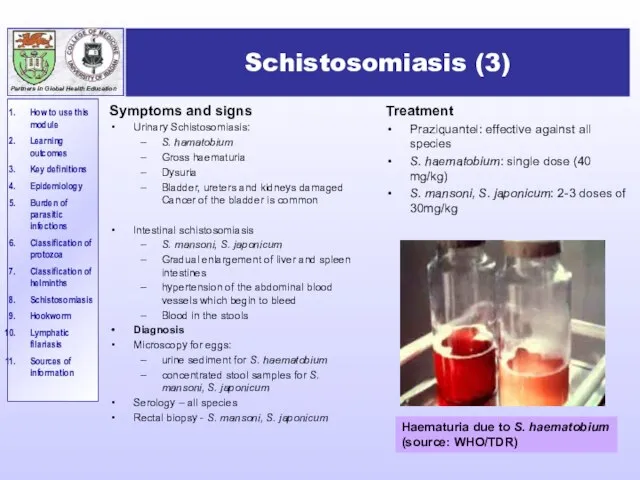 Schistosomiasis (3) Symptoms and signs Urinary Schistosomiasis: S. hamatobium Gross haematuria Dysuria