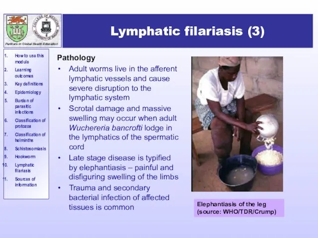 Lymphatic filariasis (3) Pathology Adult worms live in the afferent lymphatic vessels