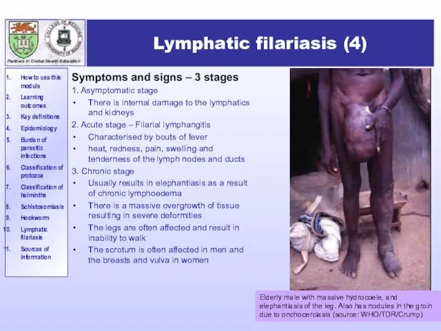 Lymphatic filariasis (4) Symptoms and signs – 3 stages 1. Asymptomatic stage