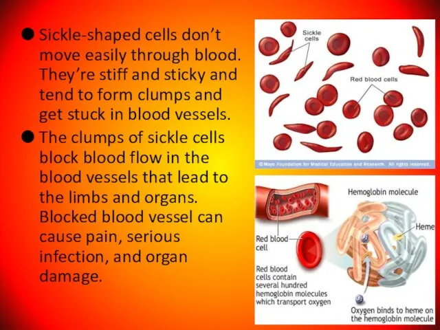 Sickle-shaped cells don’t move easily through blood. They’re stiff and sticky and