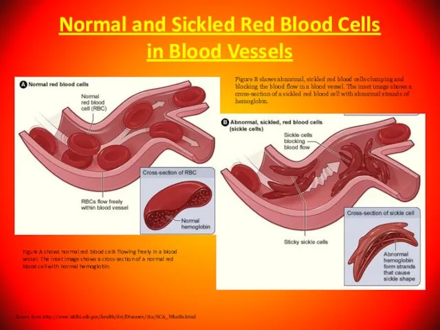 Normal and Sickled Red Blood Cells in Blood Vessels Figure A shows
