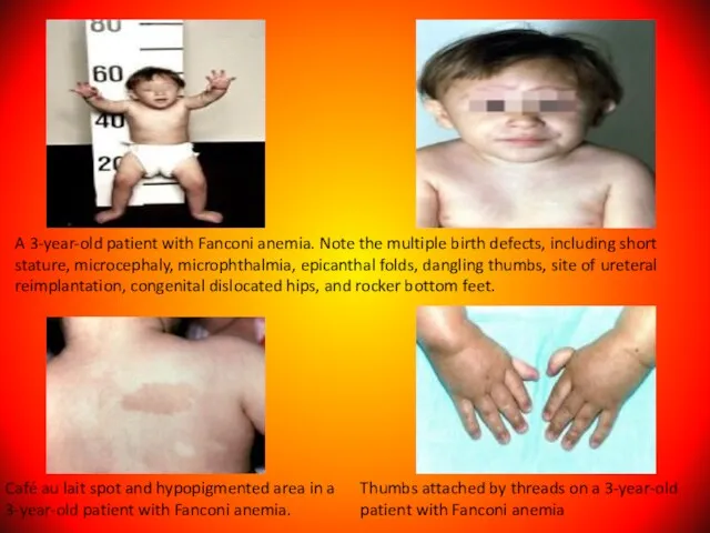 A 3-year-old patient with Fanconi anemia. Note the multiple birth defects, including