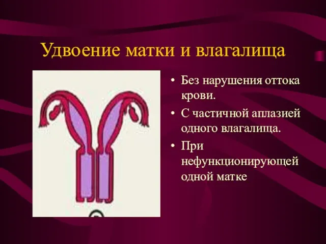 Удвоение матки и влагалища Без нарушения оттока крови. С частичной аплазией одного