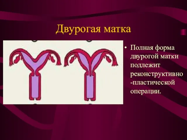 Двурогая матка Полная форма двурогой матки подлежит реконструктивно-пластической операции.