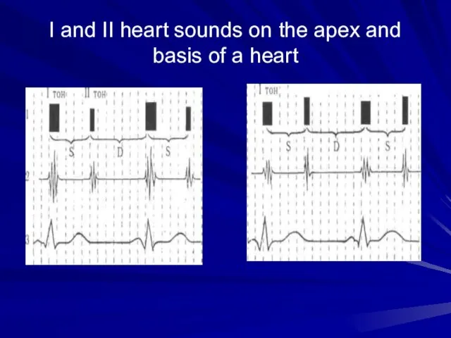 I and II heart sounds on the apex and basis of a heart