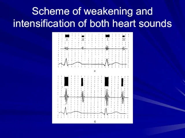 Scheme of weakening and intensification of both heart sounds