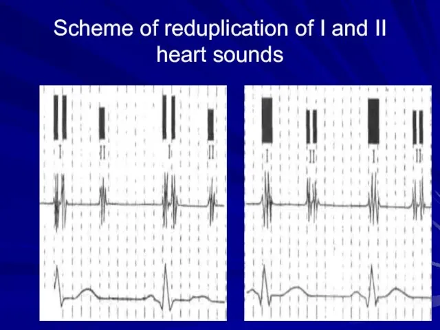 Scheme of reduplication of I and II heart sounds