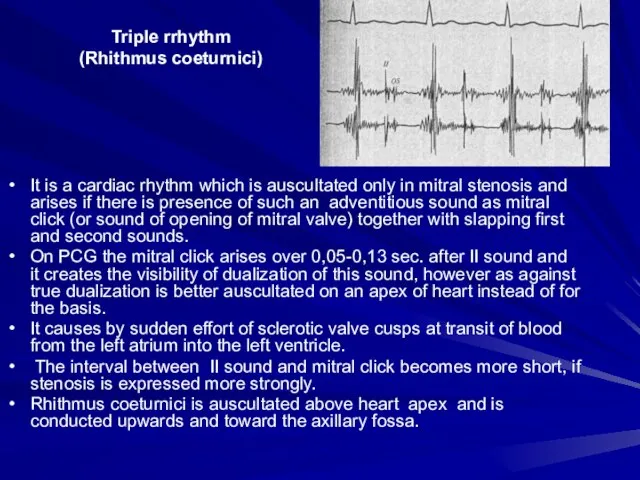 Triple rrhythm (Rhithmus coeturnici) It is a cardiac rhythm which is auscultated