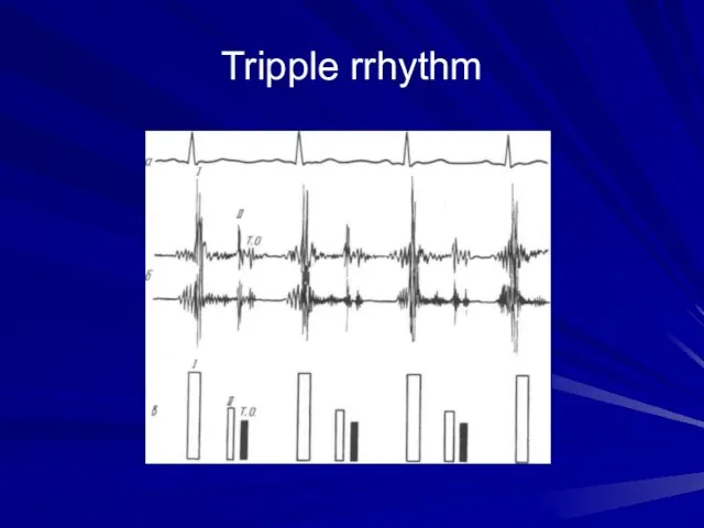 Tripple rrhythm