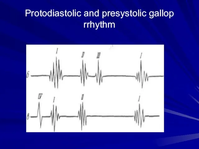 Protodiastolic and presystolic gallop rrhythm