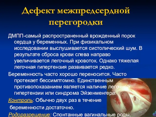 Дефект межпредсердной перегородки ДМПП-самый распространенный врожденный порок сердца у беременных. При физикальном