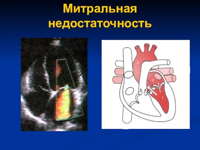 Митральная недостаточность